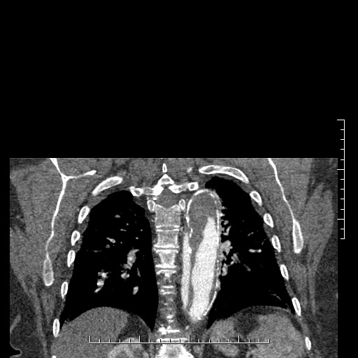 File:Aortic dissection- Stanford A (Radiopaedia 35729-37268 E 2).jpg
