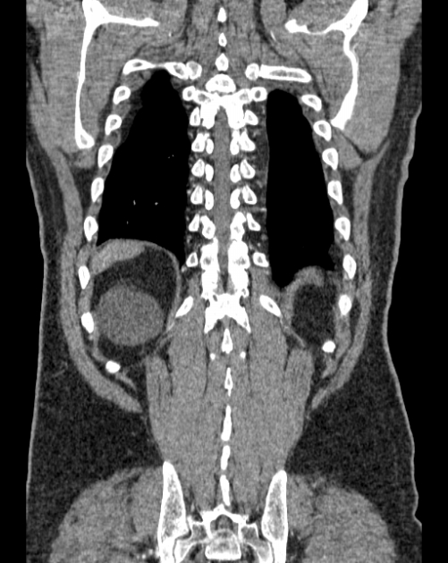 Aortic dissection (Radiopaedia 44411-48061 A 61).jpg