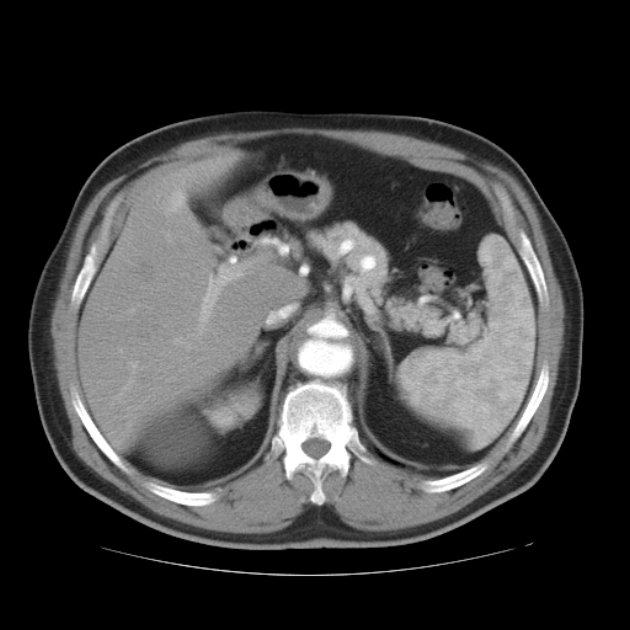 Aortic dissection (Radiopaedia 44411-48061 C 27).jpg