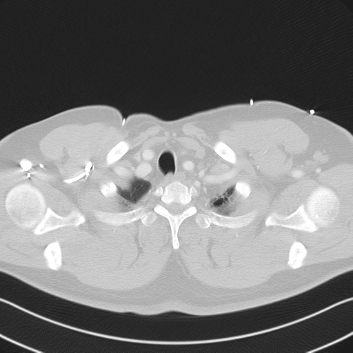 File:Aortic dissection (Radiopaedia 50763-56234 Axial lung window 11).png