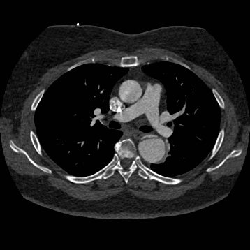Aortic dissection (Radiopaedia 57969-64959 A 137).jpg