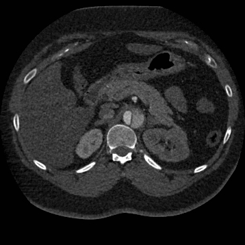 File:Aortic dissection (Radiopaedia 57969-64959 A 347).jpg