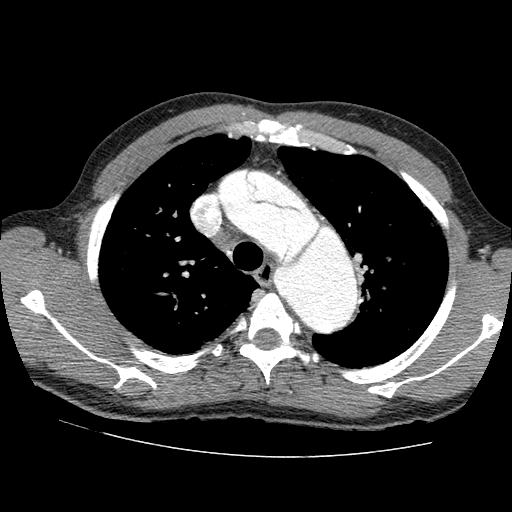 File:Aortic dissection - Stanford A -DeBakey I (Radiopaedia 28339-28587 B 15).jpg