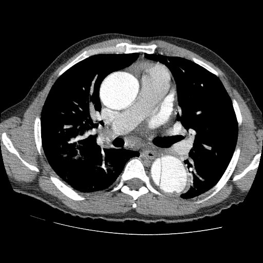 File:Aortic dissection - Stanford A -DeBakey I (Radiopaedia 28339-28587 B 40).jpg