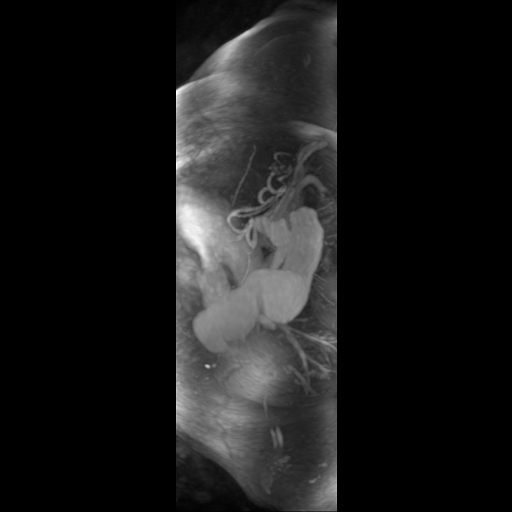 Aortic dissection - Stanford A - DeBakey I (Radiopaedia 23469-23551 D 13).jpg