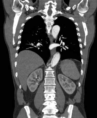 File:Aortic dissection - Stanford type B (Radiopaedia 73648-84437 B 80).jpg