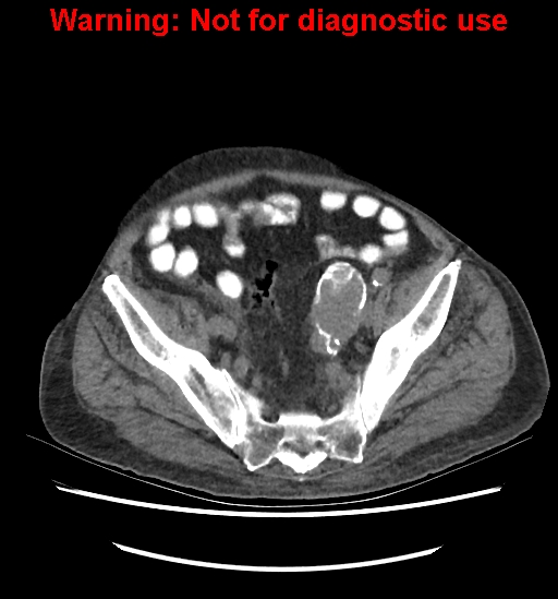 File:Aortic graft infection (Radiopaedia 44979-48907 Axial non-contrast 77).jpg