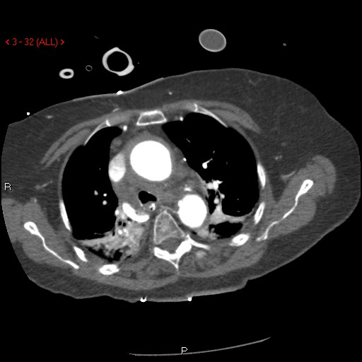 File:Aortic intramural hematoma (Radiopaedia 27746-28001 A 32).jpg