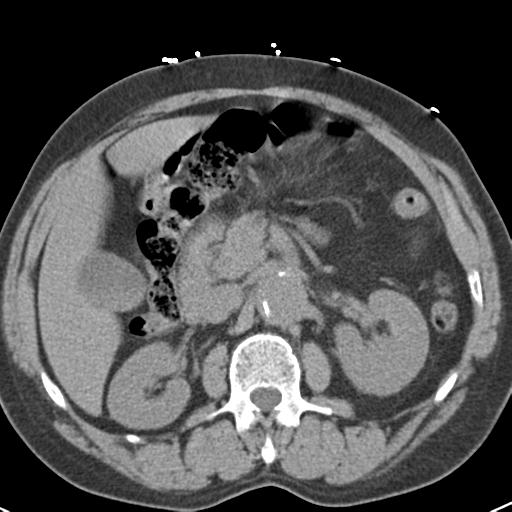 Aortic intramural hematoma (Radiopaedia 31139-31838 Axial non-contrast 59).jpg