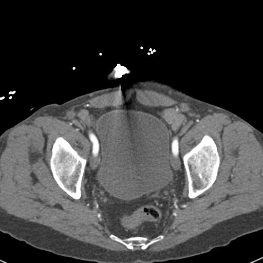 File:Aortic intramural hematoma (Radiopaedia 31139-31838 B 155).jpg