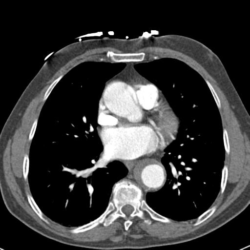 Aortic intramural hematoma (Radiopaedia 31139-31838 B 52).jpg