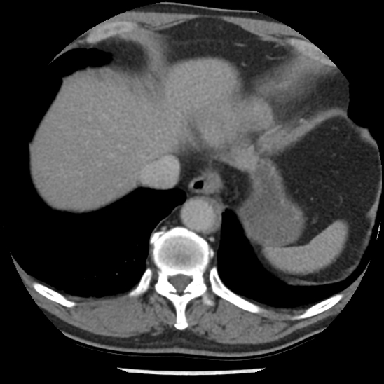 Aortic intramural hematoma (type B) (Radiopaedia 79323-92387 Axial C+ delayed 46).jpg