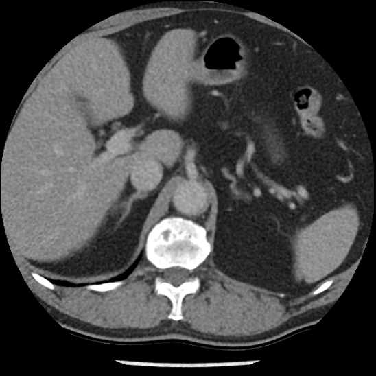 File:Aortic intramural hematoma (type B) (Radiopaedia 79323-92387 Axial C+ delayed 57).jpg