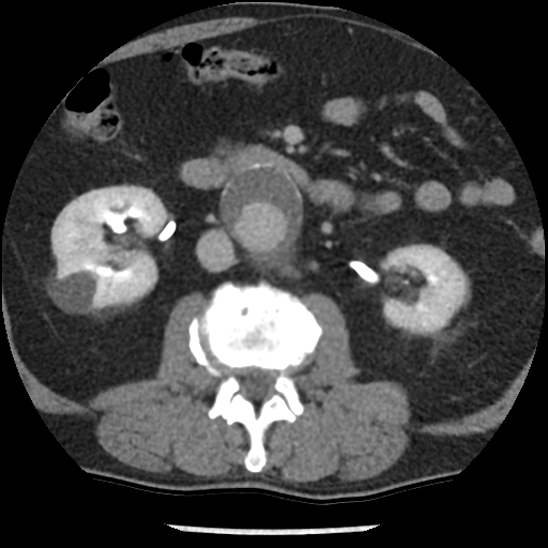 File:Aortic intramural hematoma (type B) (Radiopaedia 79323-92387 Axial C+ delayed 72).jpg