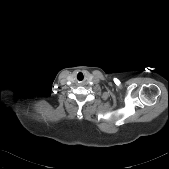 Aortic intramural hematoma with dissection and intramural blood pool (Radiopaedia 77373-89491 B 17).jpg