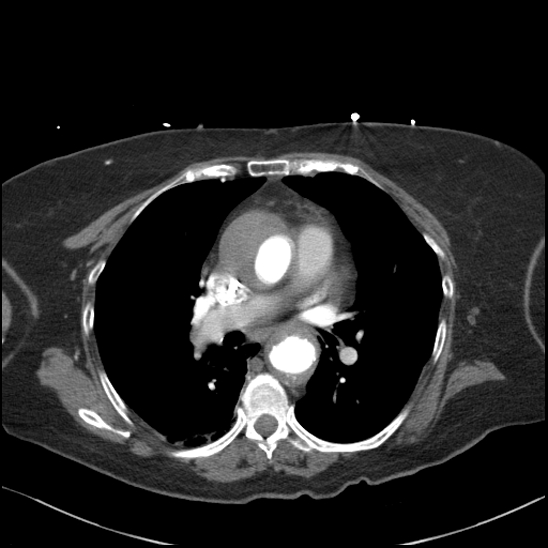 Aortic intramural hematoma with dissection and intramural blood pool (Radiopaedia 77373-89491 B 59).jpg