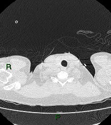 File:Aortic valve endocarditis (Radiopaedia 87209-103485 Axial lung window 3).jpg