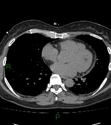 File:Aortic valve endocarditis (Radiopaedia 87209-103485 Axial non-contrast 64).jpg