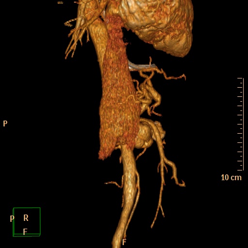 File:Aorto-left renal vein fistula (Radiopaedia 45534-49628 D 17).jpg