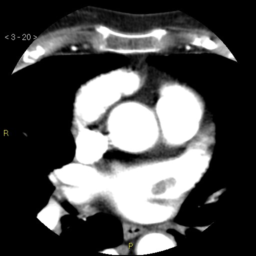 Aortoiliac occlusive disease (Radiopaedia 16828-16548 A 20).jpg