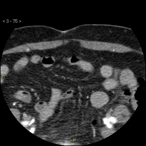 Aortoiliac occlusive disease (Radiopaedia 16828-16548 A 75).jpg