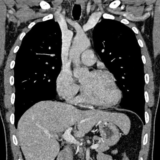 Apical lung mass mimic - neurogenic tumor (Radiopaedia 59918-67521 B 56).jpg