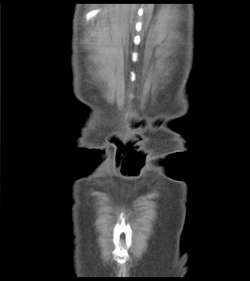 File:Appendiceal abscesses (Radiopaedia 50999-56542 Coronal non-contrast 54).png