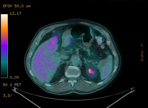 Appendiceal adenocarcinoma complicated by retroperitoneal abscess (Radiopaedia 58007-65041 Axial PET-CT 108).jpg