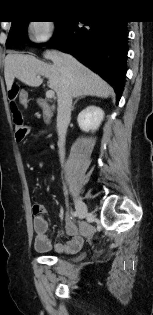 Appendiceal hemorrhage (Radiopaedia 70830-81025 Sagittal C+ delayed 45).jpg
