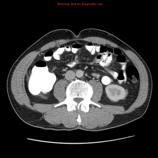 Appendicitis and renal cell carcinoma (Radiopaedia 17063-16760 A 32).jpg