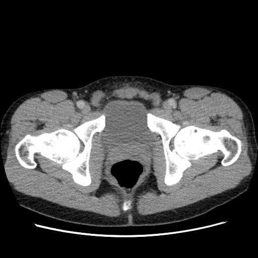 File:Appendicitis complicated by post-operative collection (Radiopaedia 35595-37114 A 85).jpg