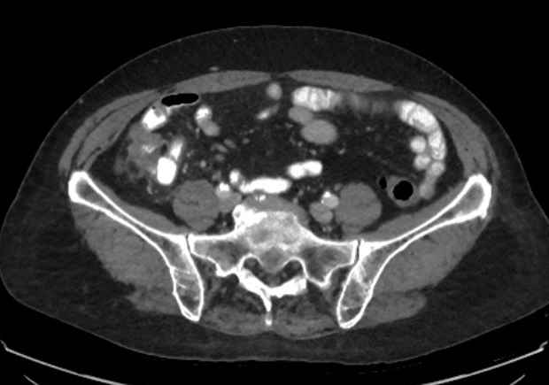 Appendicitis due to chicken fibula (Radiopaedia 74314-85198 A 18).jpg
