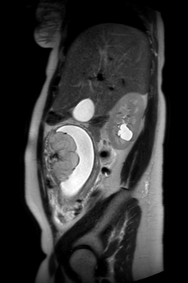 Appendicitis in gravida (MRI) (Radiopaedia 89433-106395 Sagittal T2 48).jpg