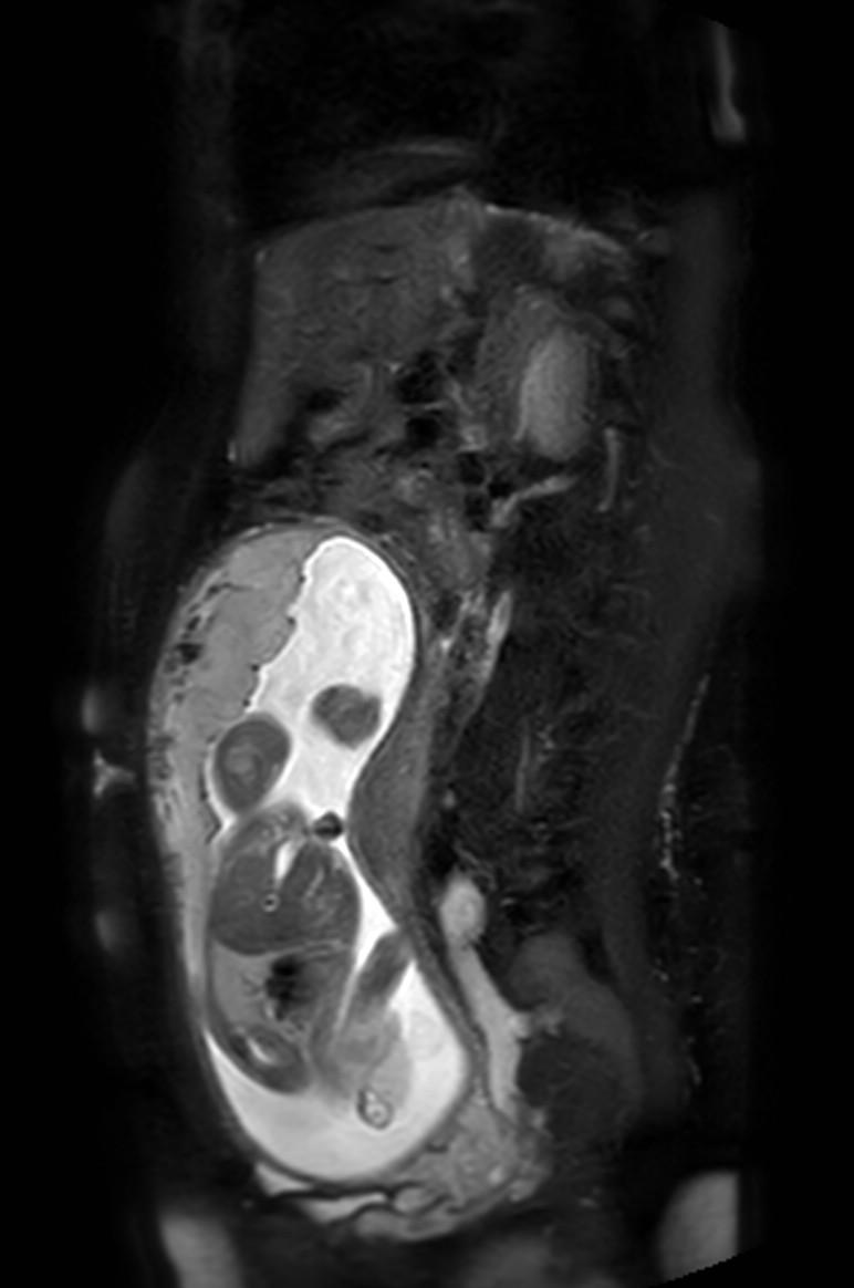Appendicitis in gravida (MRI) (Radiopaedia 89433-106395 Sagittal T2 SPAIR 26).jpg