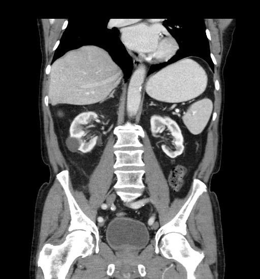 File:Appendicitis with localized perforation and abscess formation (Radiopaedia 49035-54130 B 29).jpg