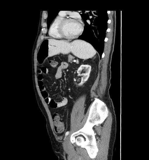 Appendicitis with localized perforation and abscess formation (Radiopaedia 49035-54130 C 44).jpg
