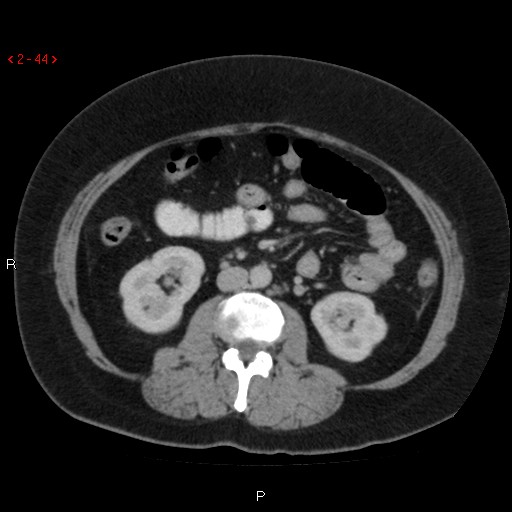 File:Appendicitis with microperforation- promontoric type (Radiopaedia 27268-27442 C 32).jpg