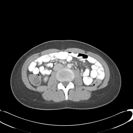 File:Appendicitis with minimal stranding but appendicolith (Radiopaedia 29035-29397 A 44).jpg