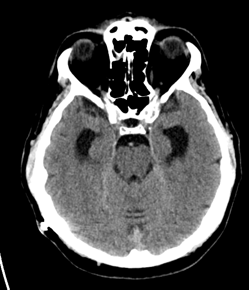 File:Aqueduct stenosis with corpus callosum hypoattenuation post shunting (Radiopaedia 37212-38973 Axial non-contrast 11).png