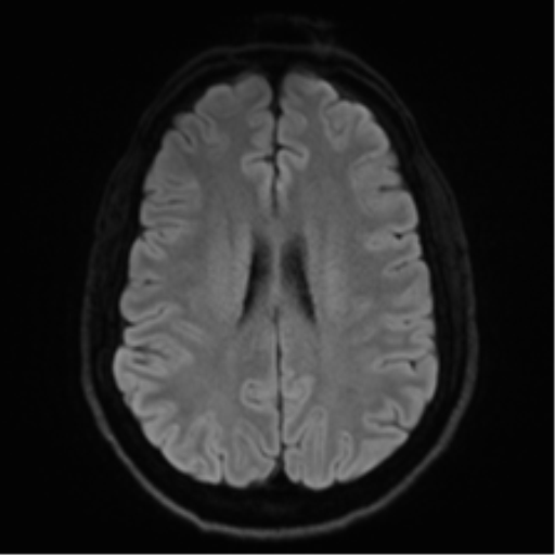 Arachnoid cyst - cerebellopontine angle (Radiopaedia 59689-67083 Axial DWI 59).png