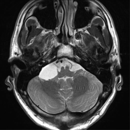 File:Arachnoid cyst - cerebellopontine angle (Radiopaedia 59689-67083 Axial T2 12).png