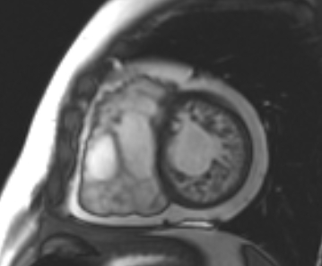 File:Arrhythmogenic right ventricular cardiomyopathy (Radiopaedia 69431-79307 Short axis cine 97).jpg