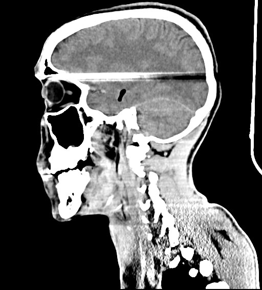 Arrow injury to the brain (Radiopaedia 72101-82607 H 25).jpg