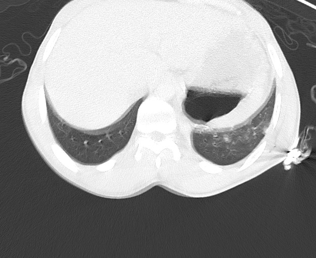 File:Arrow injury to the chest (Radiopaedia 75223-86321 Axial lung window 90).jpg