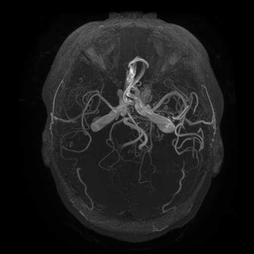 Arteriovenous malformation (Radiopaedia 71628-81999 Axial MRA 1).jpg