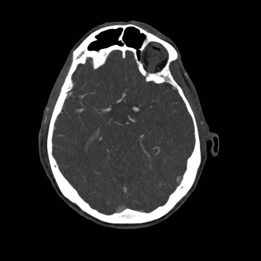 File:Artery of Percheron infarct (Radiopaedia 48088-52894 A 129).jpg