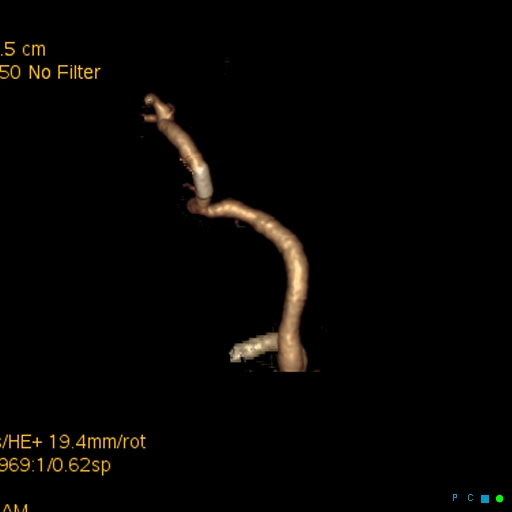 File:Artifactual basilar artery stenosis due to metallic stent (Radiopaedia 31206-31923 C 12).jpg