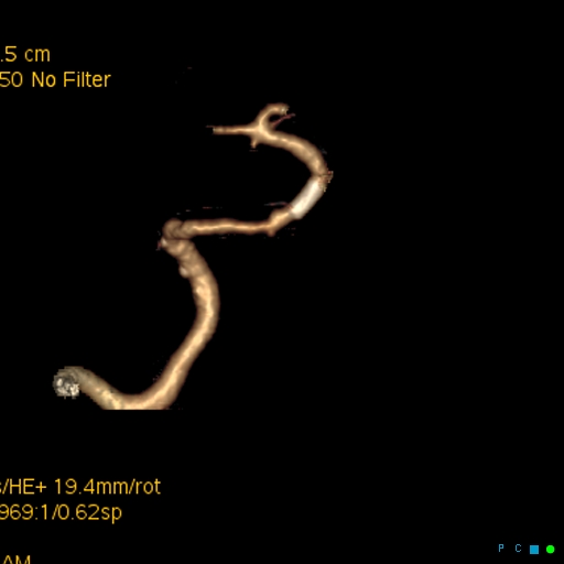 File:Artifactual basilar artery stenosis due to metallic stent (Radiopaedia 31206-31923 C 9).jpg