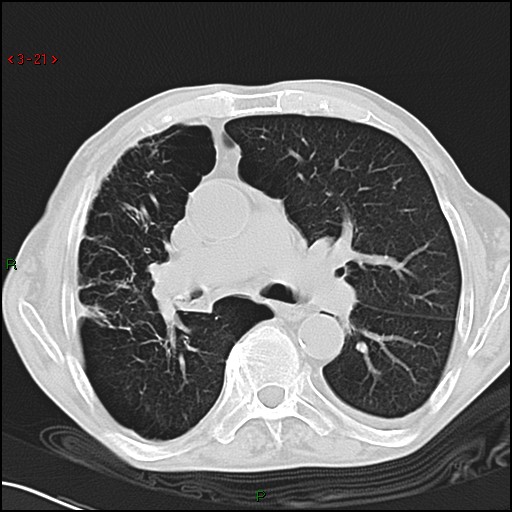 File:Aspergilloma (Radiopaedia 14842-14787 Axial lung window 21).jpg
