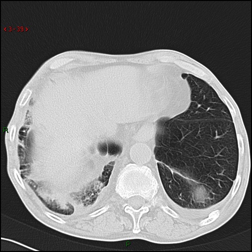 File:Aspergilloma (Radiopaedia 14842-14787 Axial lung window 39).jpg